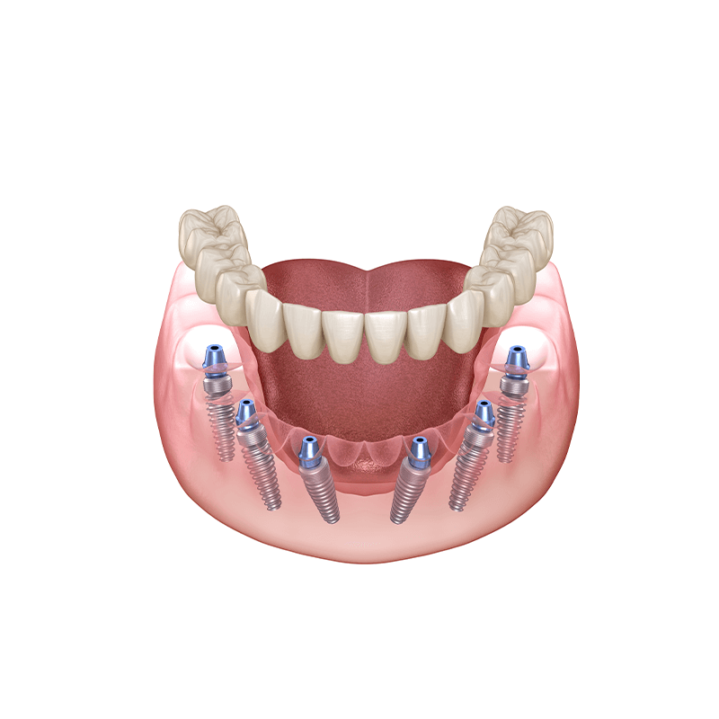 all on 4 implant