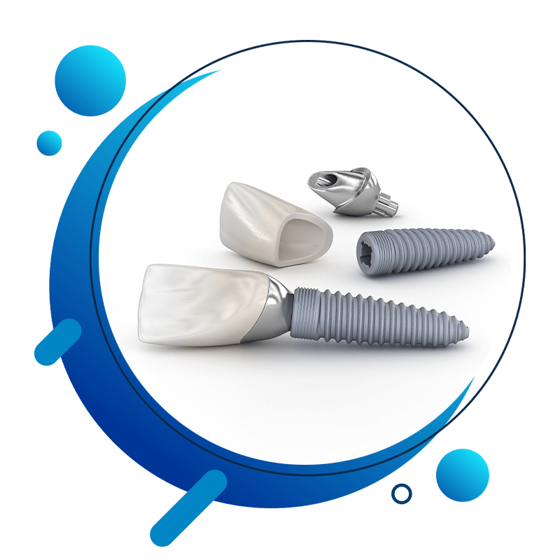 dental implant 3d model inner1