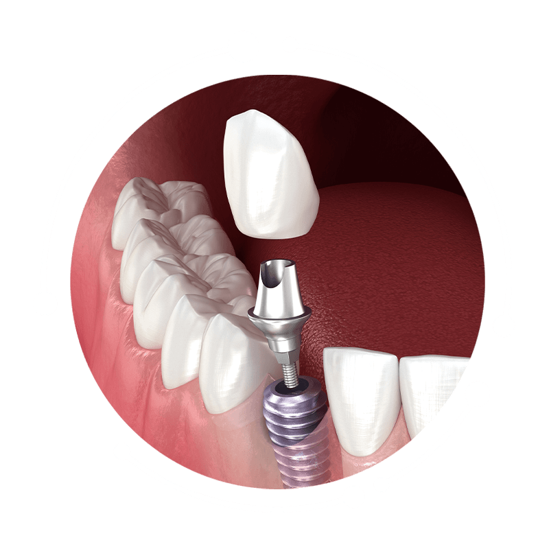 dental implant 3d model white
