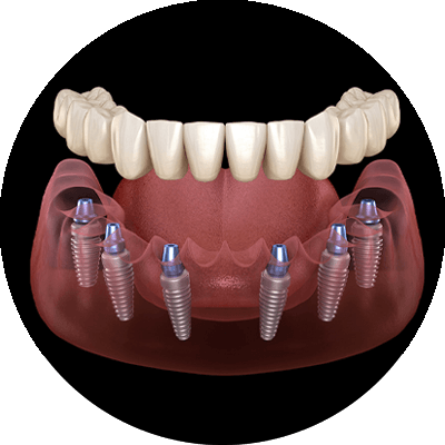 full arch implant 3d model