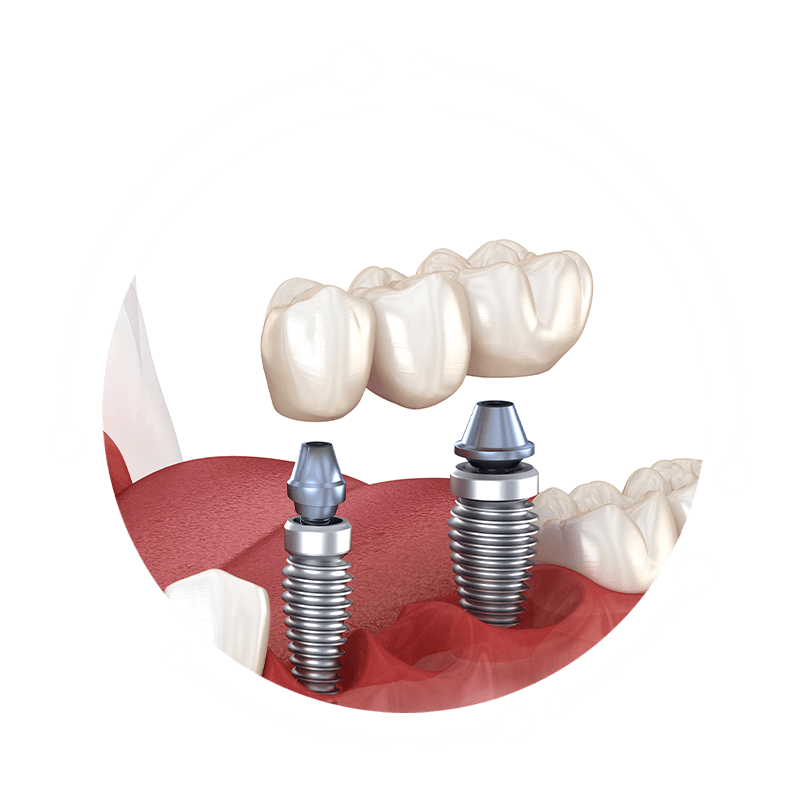 implant bridge 3d