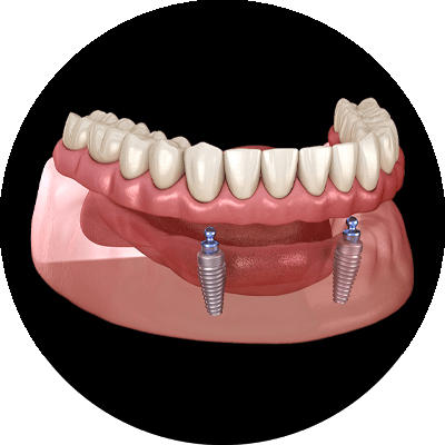 implant supported dentures
