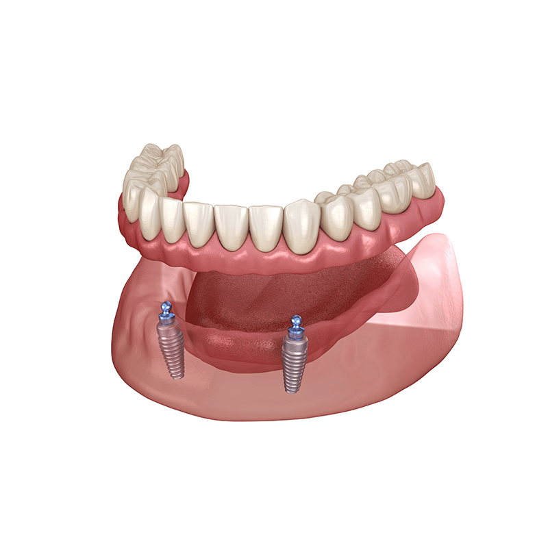 implant supporte denture