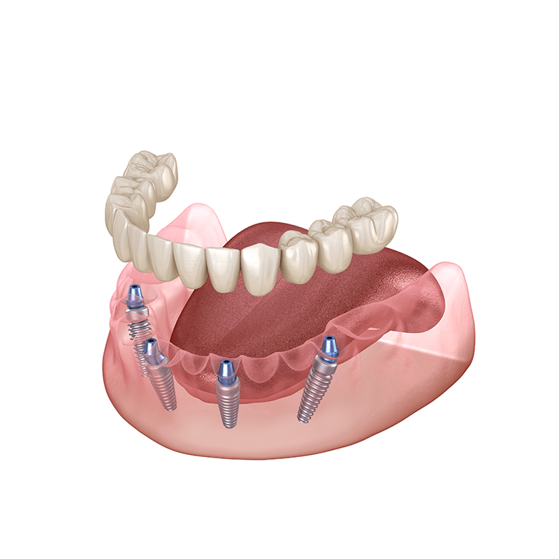full mouth implant
