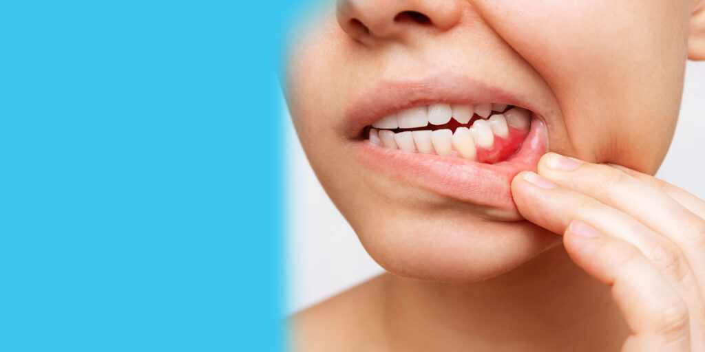 do you need invisalign