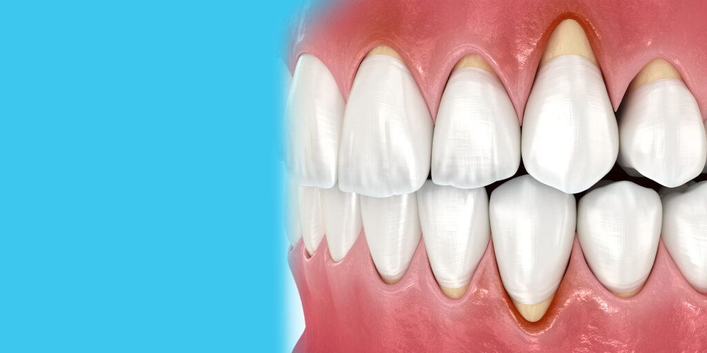 Gum Recession