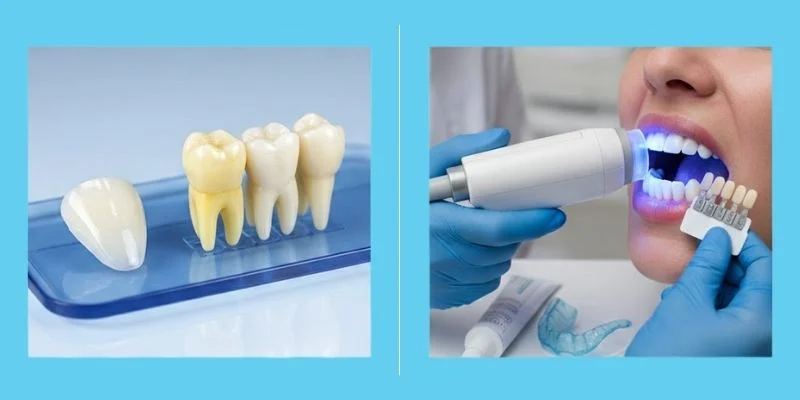 Porcelain Veneers vs Teeth Whitening