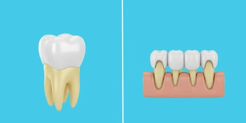dental crowns vs bridges
