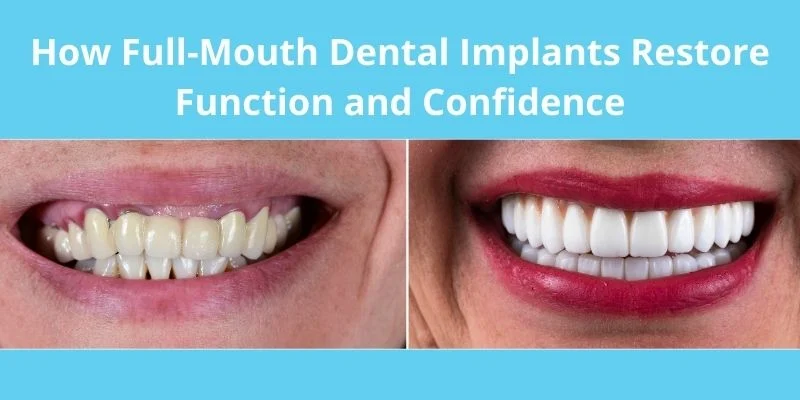 Full-Mouth Dental Implants Restore Function and Confidence