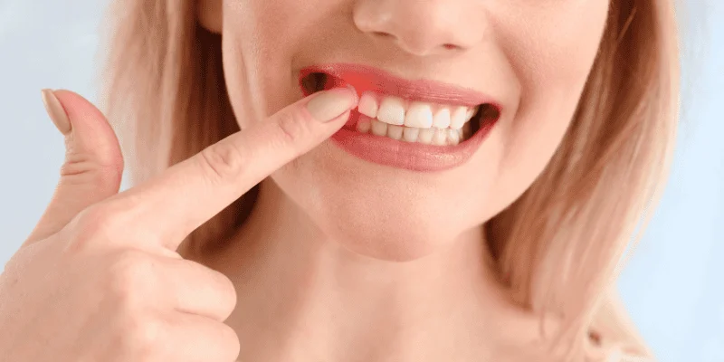 Dental Implants Gum Disease