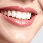 Full Mouth Dental Implants Post-Surgery Care