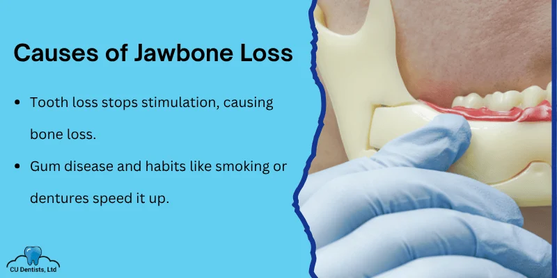 Why Bone Loss Happens in the Jaw