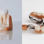 Dental Implants vs Partial Dentures