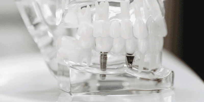 Implant Supported Bridge vs Single Implant