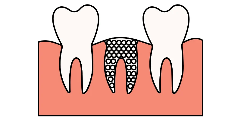 When Is Bone Grafting Needed for Implants