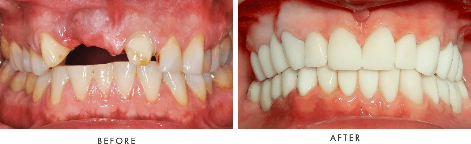 dental implants 3