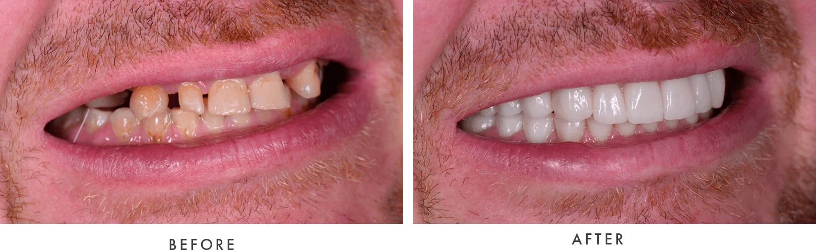 full mouth dental implants 2