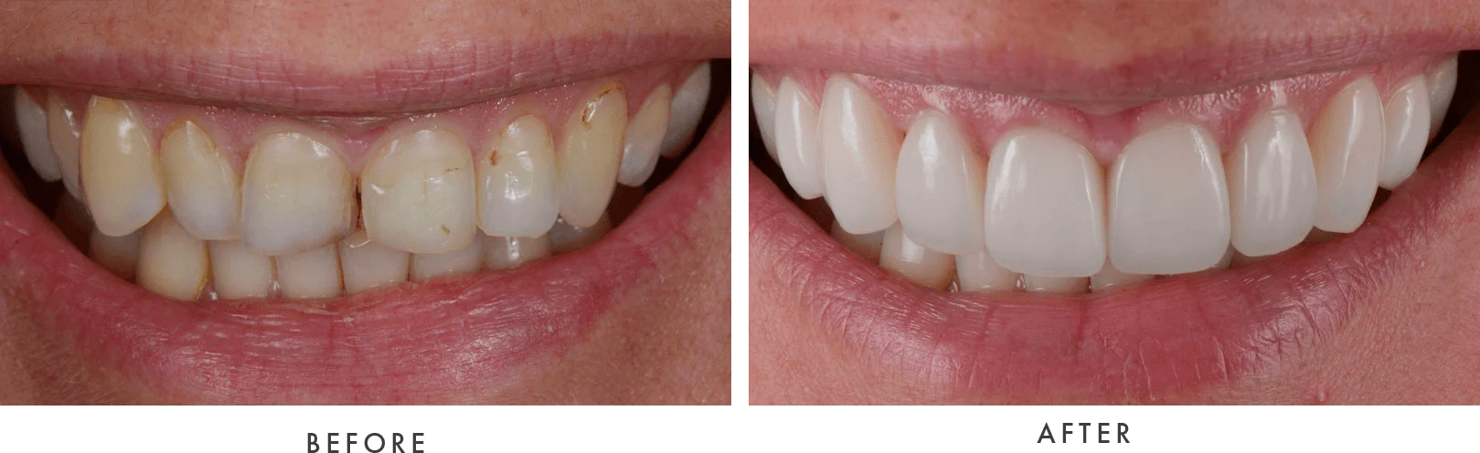 porcelain veneers 1