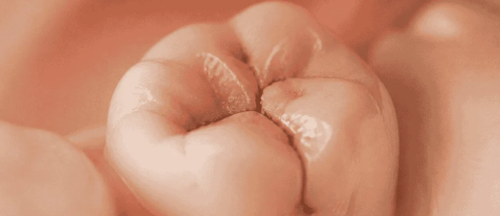 cracked molar treatment