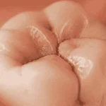 cracked molar treatment
