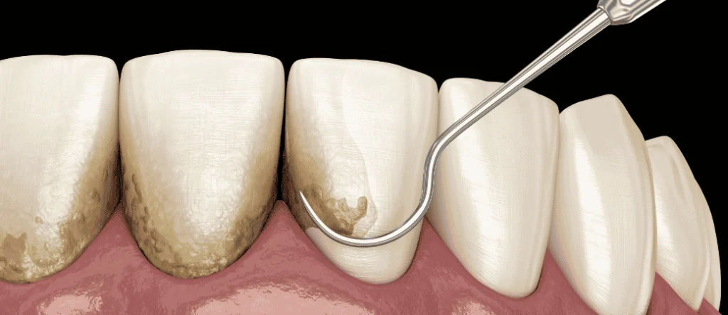 scaling and root planing vs gum surgery