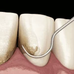 scaling and root planing vs gum surgery